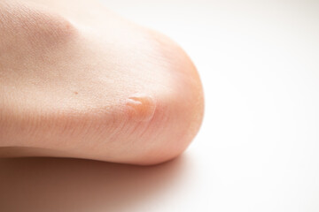 Callus on the heel. Painful corn on foot. Healthcare and medical concept.