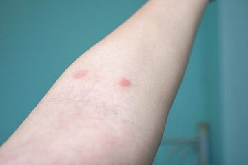 two red rash on the arm skin