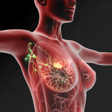 Breast cancer, lymphatics, mastocarcinoma, sentinel lymph node, 3D medical illustration