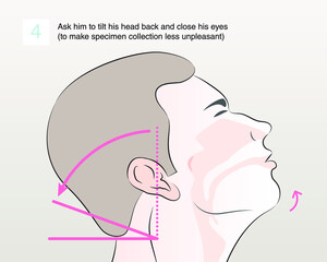 Tilt patient’s head back 70 degrees. Ask him to tilt his head back and close his eyes (to make specimen collection less unpleasant). step 4