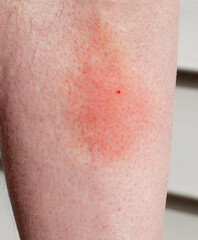 Fototapeta premium Wasp sting and surrounding irritation on shin