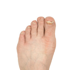 Nail fungus. The foot of a man's leg, with nails diseased with fungus. Isolated image on white...