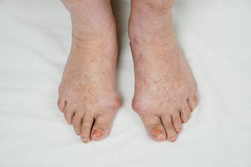 Feet of an elderly woman deformed as a result of gout