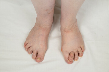 Obraz na płótnie Canvas Legs of an elderly woman with rheumatoid arthritis. Deformed rheumatoid foot