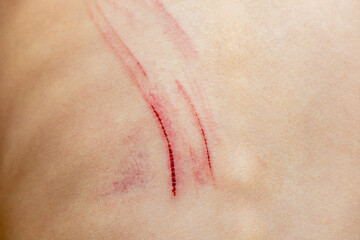 Wounds scratches on the back of a small child close up