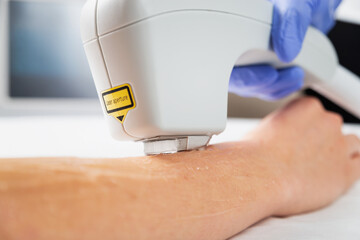 Laser hair removal of hands in a beauty salon. Hand hair removal procedure using laser hair removal technology. Close up.