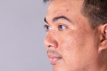 Obraz premium Face skin of asian man to show many skin problem. Men skin care concept on grey space background