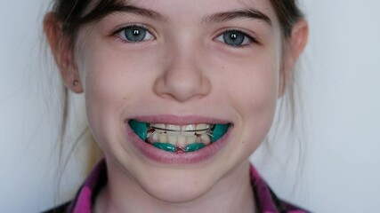 little / young smiling girl wears an orthodontic dental appliance / retainer / braces. Pediatric dentistry and orthodontics, concept