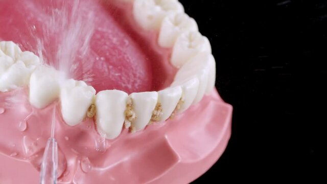Fake jaw cleaning food remains with water flosser. Dirty teeth, corn flakes, stucked food. Oral irrigator washing teeth on black background in slow motion. Full HD 240 fps