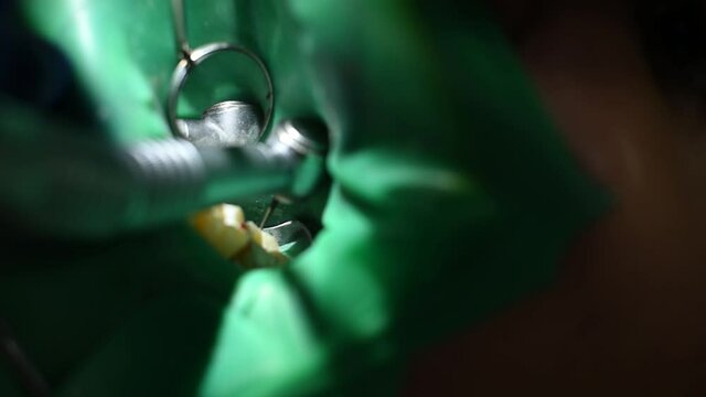 Treatment and filling of the tooth, the dentist removes the drill filling, which interferes with the bite.