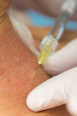 Falten am Hals reduzieren.