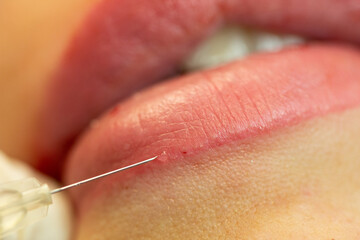 weibliche Lippen aufspritzen