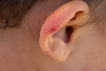 A bee sting on a child's ear with risk of anaphylactic shock
