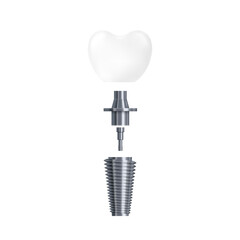 3d realistic illustration of dental tooth implant and its parts vector isolated icon