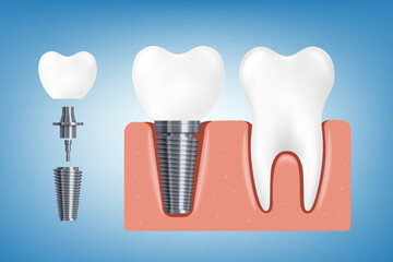 Banner with healthy tooth and dental implant realistic vector illustration.