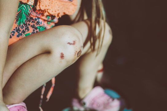 Young Girl With Badly Bruised Knees Standing On A Hover Board