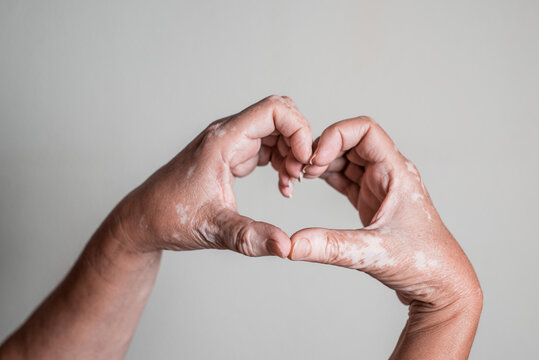 Caucasian hands with vitiligo skin disorder forming a heart with fingers on isolated background.