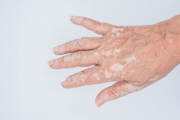 Vitiligo skin disease on hand closeup on isolated white background.