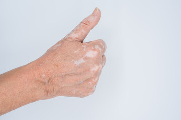 Hand with vitiligo disorder with thumb up as a sign of acceptance and victory on white background