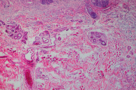 micrograph of human basal cell cancer