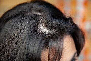 Woman shows thinning hair near the root with oily hair problems.