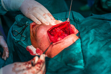 Carotid artery surgery in hospital