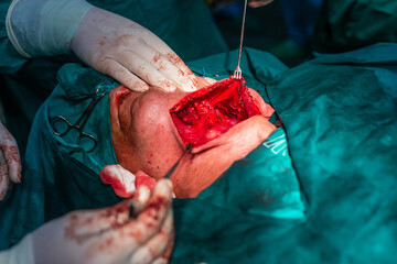 Carotid artery surgery in hospital