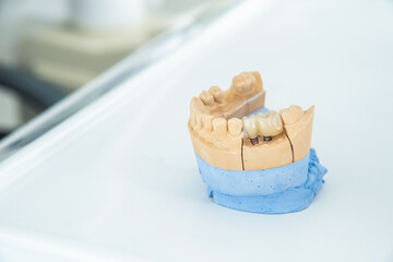An artificial jaw with a ceramic crown on implants, stands on a surgical glass in a stolmatologic office. Dentistry and treatment concept