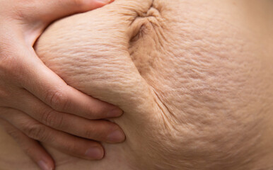 A young woman holds the skin on her stomach with her hand. Postpartum stretch marks. Skin care and...