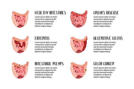 Intestines diseases. Enteritis, ulcerative colitis, Crohn's disease, polyp, colon cancer. Gastroenterology. Vector flat illustration. Perfect for flyer, medical brochure, banner, landing page, website