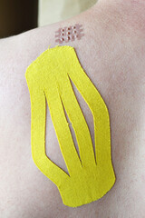 Two kynesio taping pieces on the man's scapula