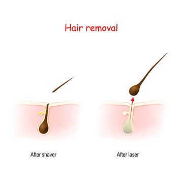 Cross Section Of The Hair And Skin After Shaving Or Wax, And After Laser Hair Removal.