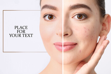 Young woman before and after acne treatment on light background with space for text