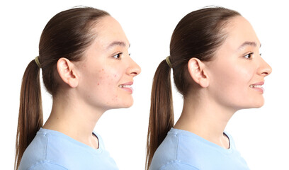 Young woman before and after acne treatment on white background