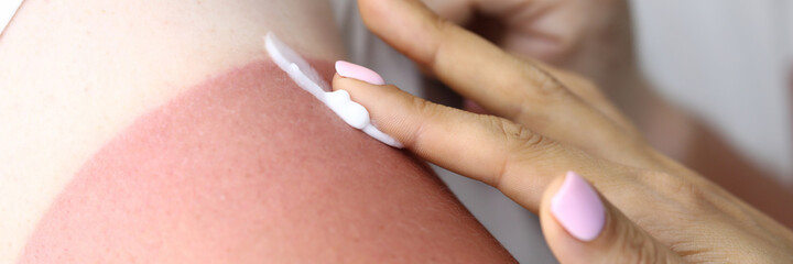Woman's hand applies cream to burn to treat sunburn. Consequences of sunburn and their treatment concept