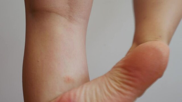 A woman's foot scratches the insect bite on her leg.