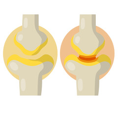 Arthritis. Disease of joints. Red sore spot. Cartoon illustration. Medical education and surgery. Bones and interosseous cartilage. Biology and anatomy