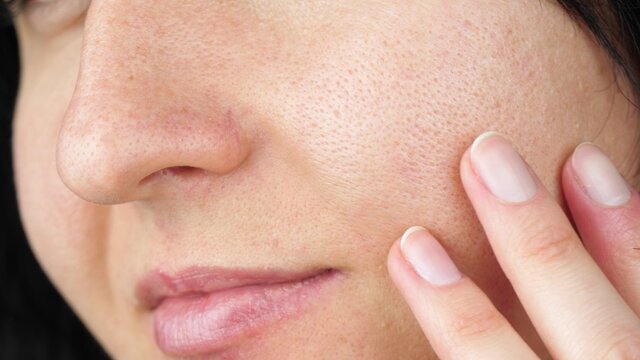 The girl touches the fingers of problem skin with enlarged pores, examining it.