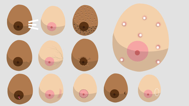 ETAPAS EN SENOS DE C&Aacute;NCER DE MAMA