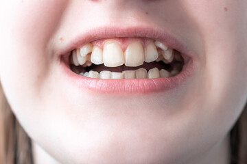Mouth with crooked teeth. Close up.