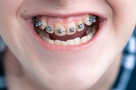 The teeth's braces on teeth of girl to equalize the teeth. Close-up. Dental concept.