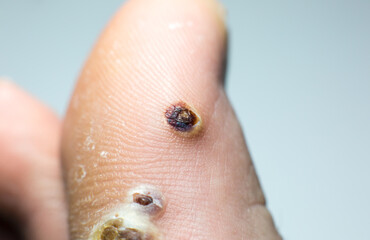 Wounds from removal of warts. Black scars. Contagious skin illness on foot. Medical treatment photo.