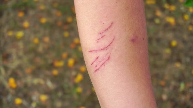 Red scratches on the skin of a man's hand, close-up, skin damage