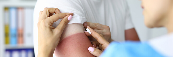Nurse applies sunburn cream to patient. Sunburn products and creams concept