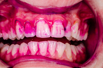 close up of a mouth of a person with stained dental plaque