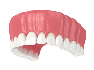 3d render of human upper jaw with black triangles