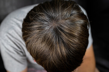 A man has hair growth, he has hair loss problems. Dry scalp, dandruff