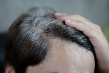 Fototapeta premium A man has hair growth, he has hair loss problems. Dry scalp, dandruff