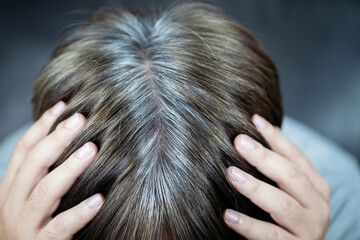 Fototapeta premium A man has hair growth, he has hair loss problems. Dry scalp, dandruff