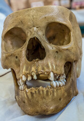 Skull With Missing Teeth-0001
